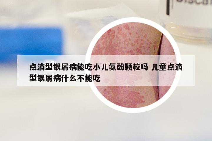 点滴型银屑病能吃小儿氨酚颗粒吗 儿童点滴型银屑病什么不能吃