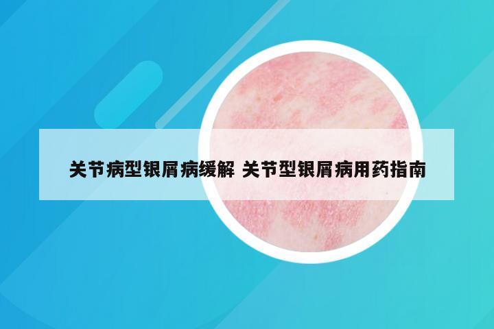 关节病型银屑病缓解 关节型银屑病用药指南