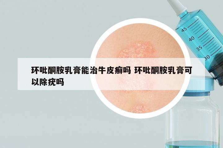 环吡酮胺乳膏能治牛皮癣吗 环吡酮胺乳膏可以除疣吗