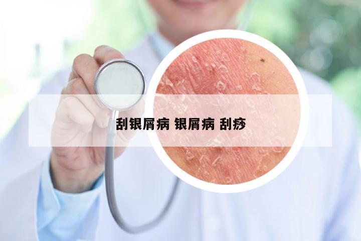 刮银屑病 银屑病 刮痧