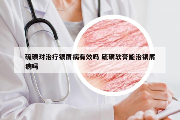 硫磺对治疗银屑病有效吗 硫磺软膏能治银屑病吗