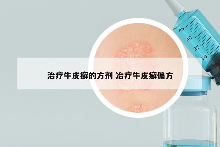 治疗牛皮癣的方剂 冶疗牛皮癣偏方