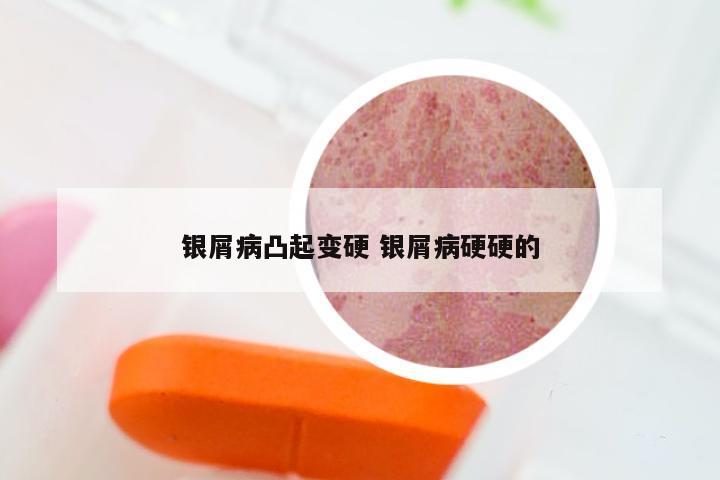 银屑病凸起变硬 银屑病硬硬的