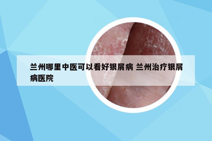 兰州哪里中医可以看好银屑病 兰州治疗银屑病医院