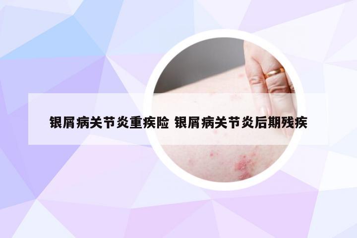 银屑病关节炎重疾险 银屑病关节炎后期残疾