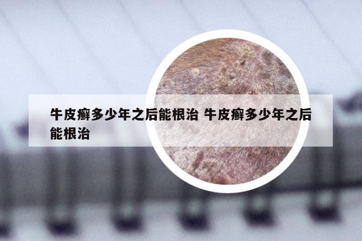 牛皮癣多少年之后能根治 牛皮癣多少年之后能根治