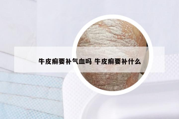 牛皮癣要补气血吗 牛皮癣要补什么