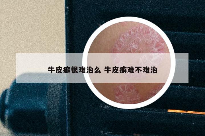 牛皮癣很难治么 牛皮癣难不难治
