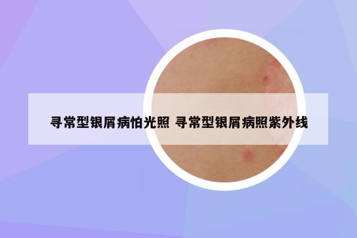 寻常型银屑病怕光照 寻常型银屑病照紫外线