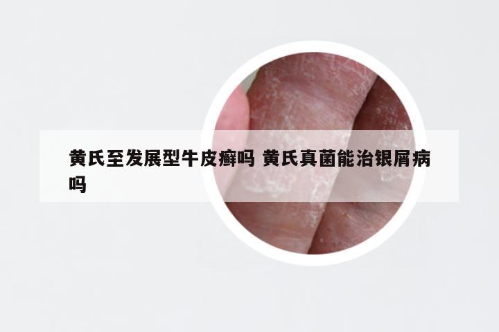 黄氏至发展型牛皮癣吗 黄氏真菌能治银屑病吗