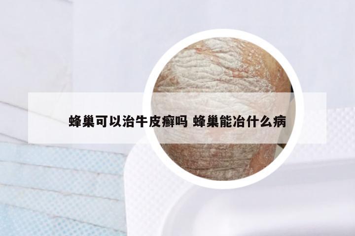 蜂巢可以治牛皮癣吗 蜂巢能冶什么病