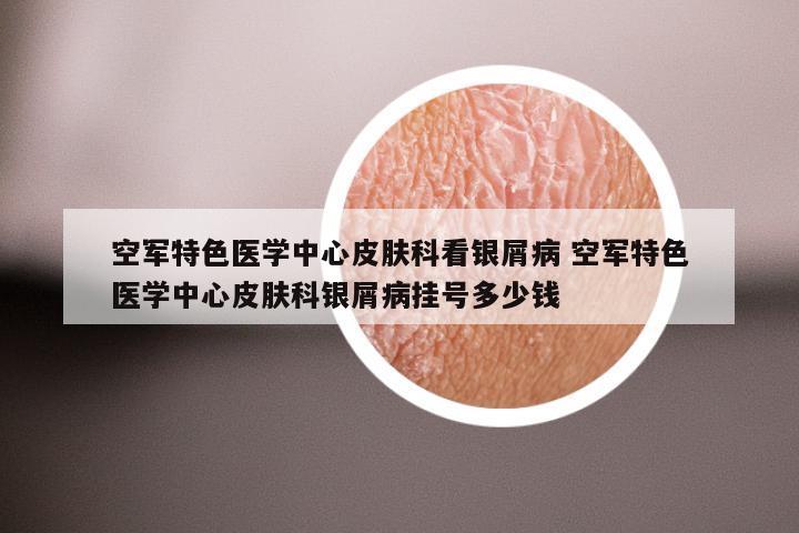 空军特色医学中心皮肤科看银屑病 空军特色医学中心皮肤科银屑病挂号多少钱