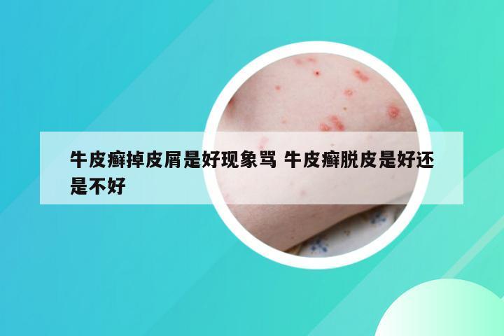 牛皮癣掉皮屑是好现象骂 牛皮癣脱皮是好还是不好