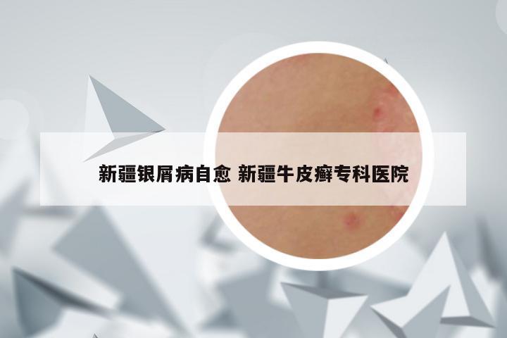新疆银屑病自愈 新疆牛皮癣专科医院