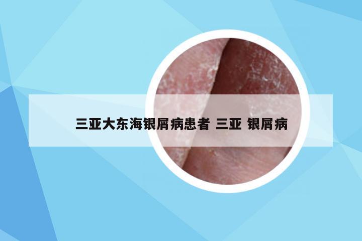 三亚大东海银屑病患者 三亚 银屑病