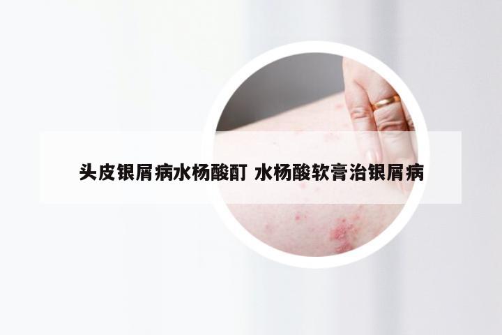 头皮银屑病水杨酸酊 水杨酸软膏治银屑病