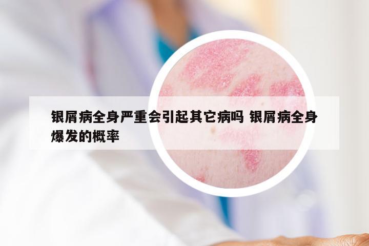 银屑病全身严重会引起其它病吗 银屑病全身爆发的概率