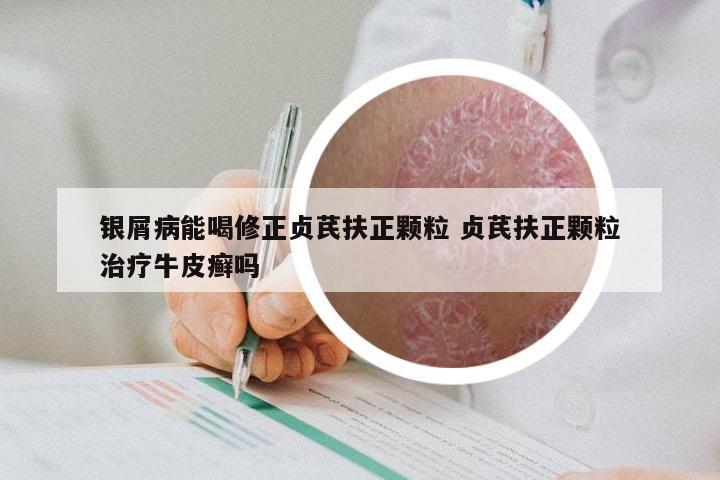 银屑病能喝修正贞芪扶正颗粒 贞芪扶正颗粒治疗牛皮癣吗