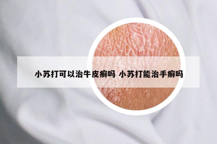 小苏打可以治牛皮癣吗 小苏打能治手癣吗