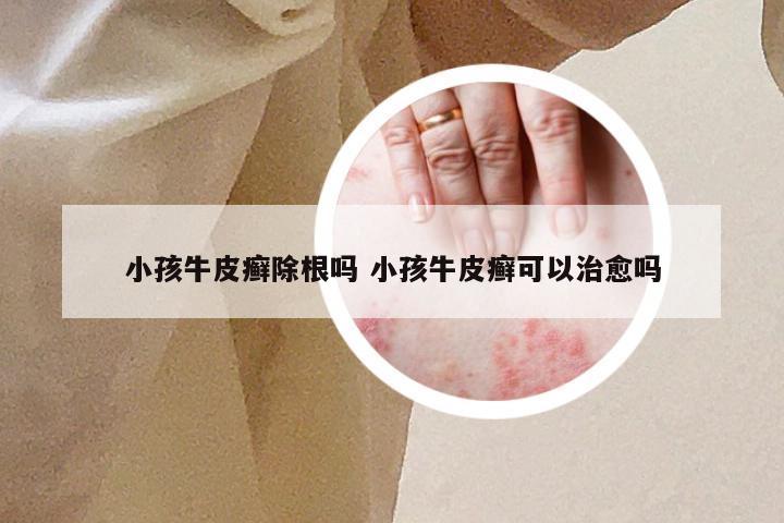 小孩牛皮癣除根吗 小孩牛皮癣可以治愈吗