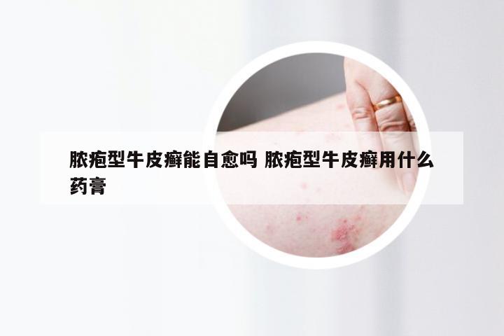 脓疱型牛皮癣能自愈吗 脓疱型牛皮癣用什么药膏