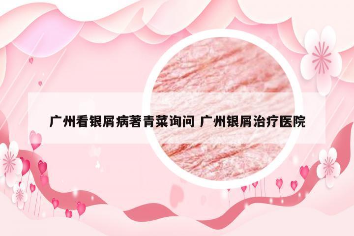 广州看银屑病著青菜询问 广州银屑治疗医院