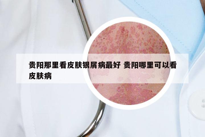 贵阳那里看皮肤银屑病最好 贵阳哪里可以看皮肤病