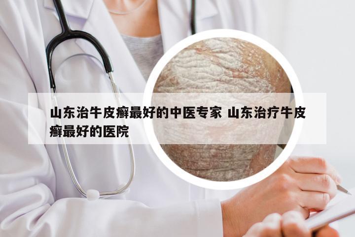 山东治牛皮癣最好的中医专家 山东治疗牛皮癣最好的医院
