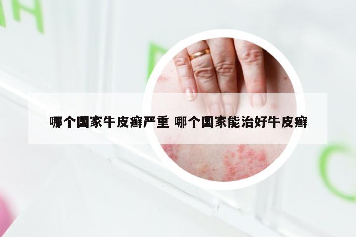 哪个国家牛皮癣严重 哪个国家能治好牛皮癣