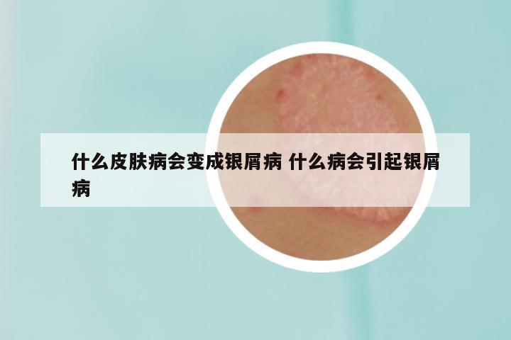 什么皮肤病会变成银屑病 什么病会引起银屑病