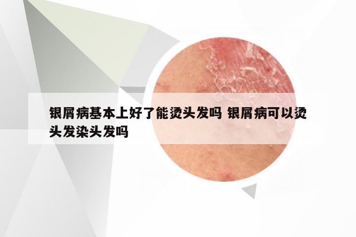 银屑病基本上好了能烫头发吗 银屑病可以烫头发染头发吗