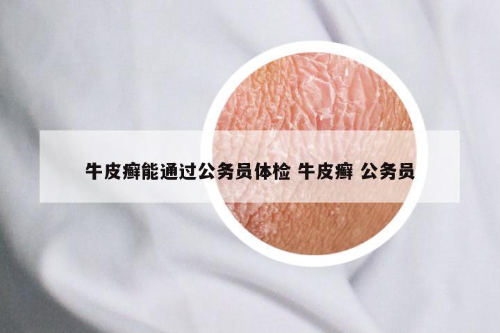 牛皮癣能通过公务员体检 牛皮癣 公务员