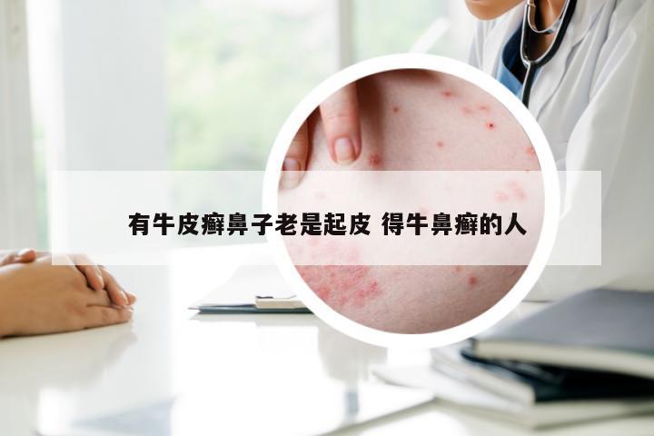 有牛皮癣鼻子老是起皮 得牛鼻癣的人