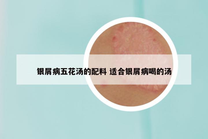银屑病五花汤的配料 适合银屑病喝的汤