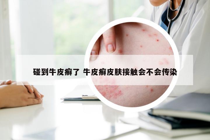 碰到牛皮癣了 牛皮癣皮肤接触会不会传染