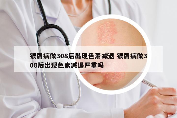 银屑病做308后出现色素减退 银屑病做308后出现色素减退严重吗
