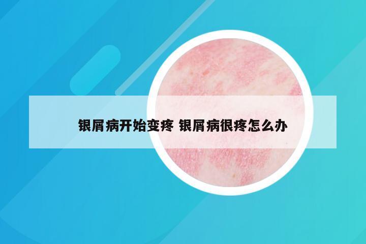 银屑病开始变疼 银屑病很疼怎么办
