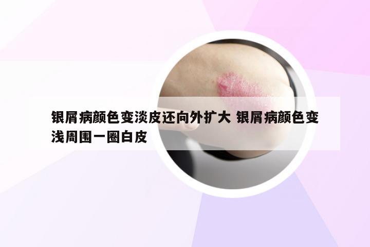 银屑病颜色变淡皮还向外扩大 银屑病颜色变浅周围一圈白皮