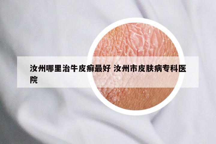 汝州哪里治牛皮癣最好 汝州市皮肤病专科医院