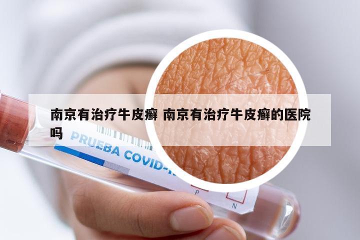 南京有治疗牛皮癣 南京有治疗牛皮癣的医院吗