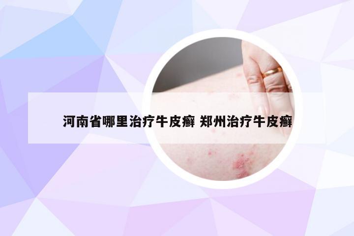 河南省哪里治疗牛皮癣 郑州治疗牛皮癣