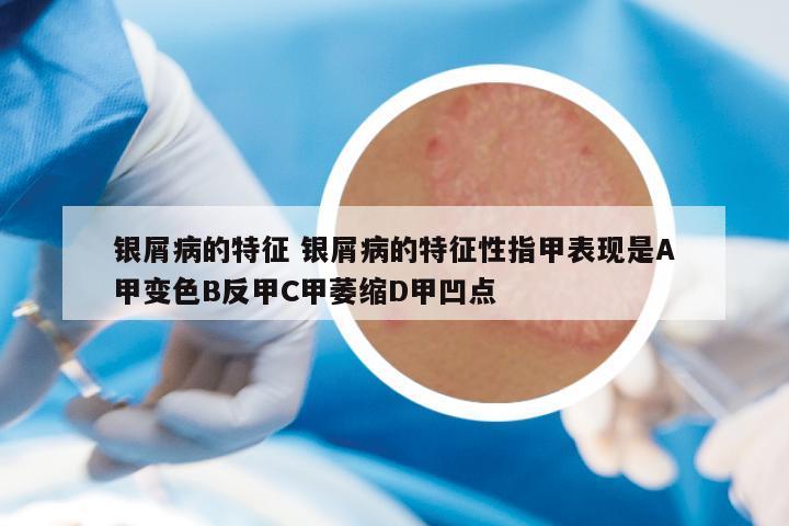 银屑病的特征 银屑病的特征性指甲表现是A甲变色B反甲C甲萎缩D甲凹点