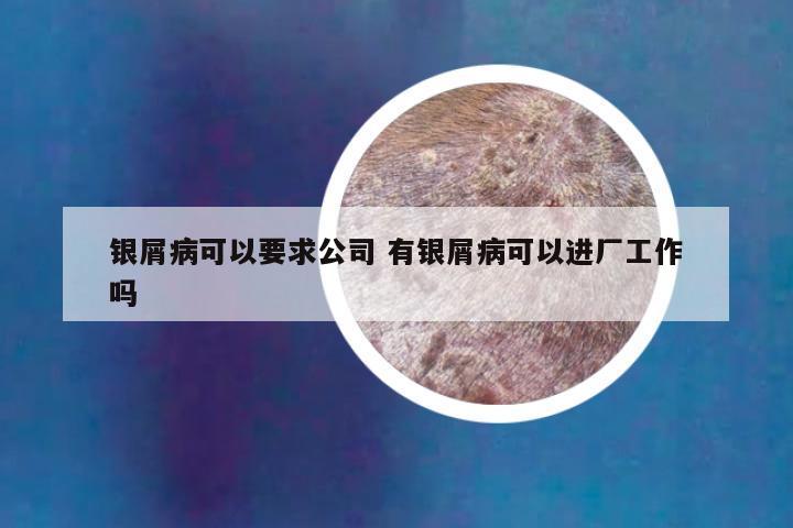 银屑病可以要求公司 有银屑病可以进厂工作吗