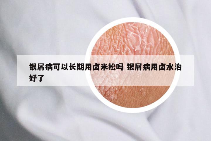 银屑病可以长期用卤米松吗 银屑病用卤水治好了