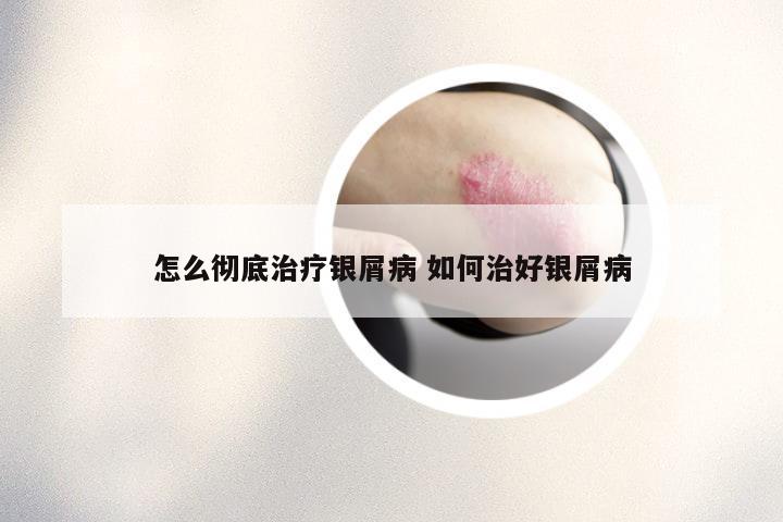 怎么彻底治疗银屑病 如何治好银屑病