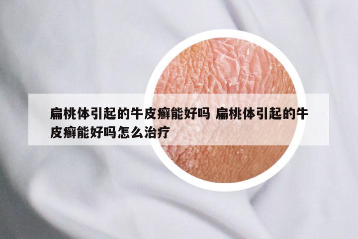 扁桃体引起的牛皮癣能好吗 扁桃体引起的牛皮癣能好吗怎么治疗
