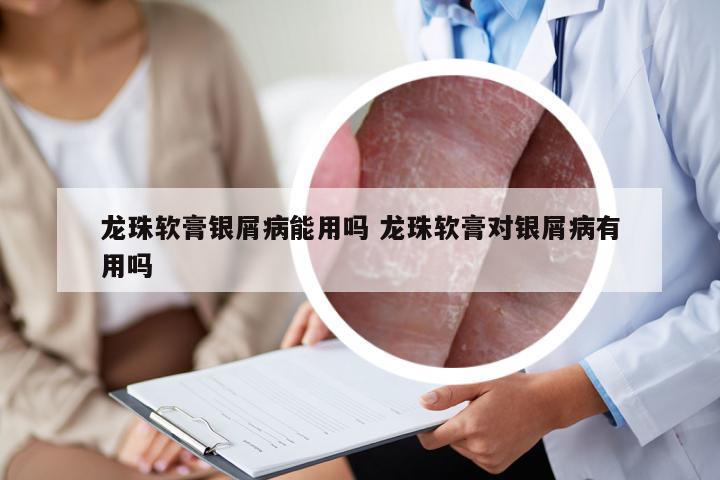 龙珠软膏银屑病能用吗 龙珠软膏对银屑病有用吗