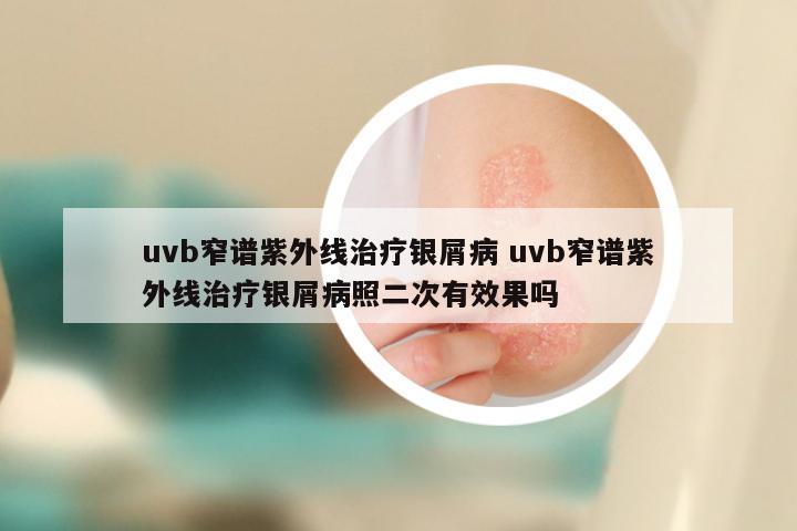 uvb窄谱紫外线治疗银屑病 uvb窄谱紫外线治疗银屑病照二次有效果吗