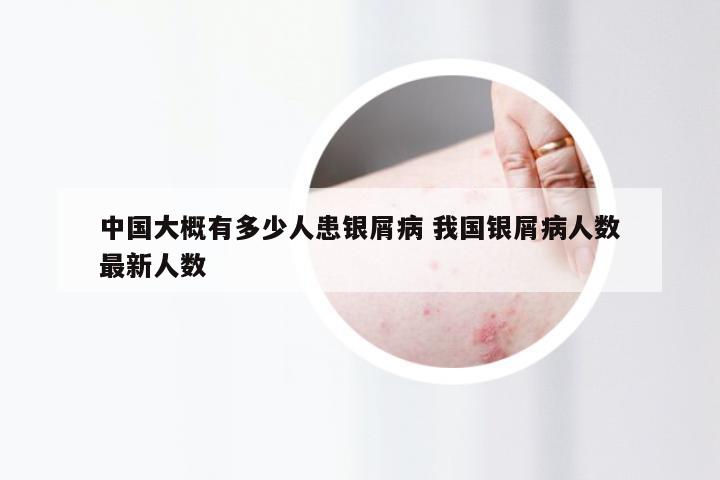 中国大概有多少人患银屑病 我国银屑病人数最新人数