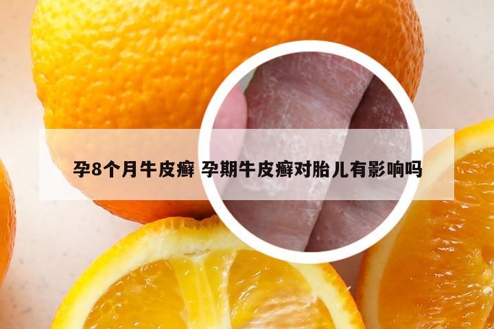 孕8个月牛皮癣 孕期牛皮癣对胎儿有影响吗